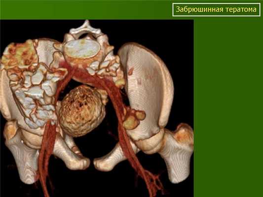 Забрюшинная тератома (3D реконструкция)