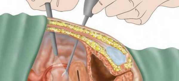 лапароскопия гидросальпинкса