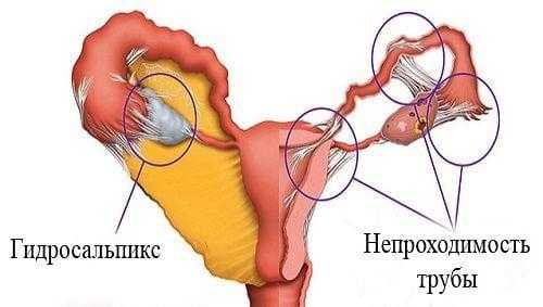 левосторонний гидросальпинкс