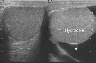 Гидроцеле
