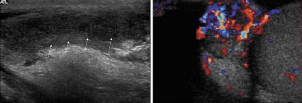 Воспаление яичка