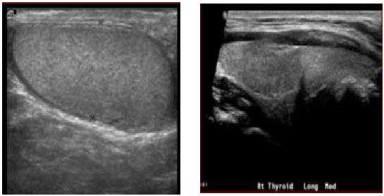 Водянка яичка
