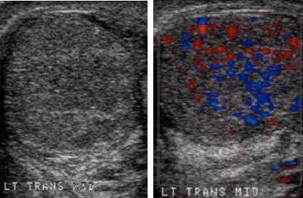 Нормальное кровоснабжение яичка