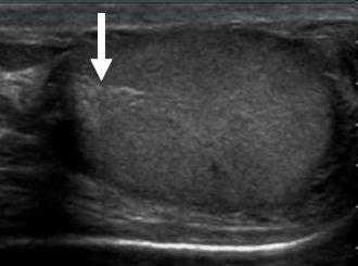 Перегородка яичка