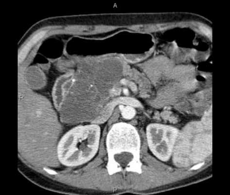 КТ поджелудочной железы фото