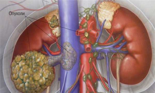 опухоль почки