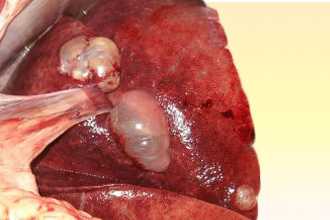 Кисты в печени