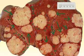 Метастазы в печени