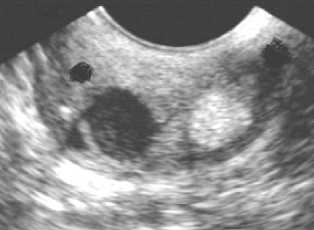 Фото кисты шейки матки на УЗИ