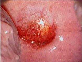 Фото кисты шейки матки