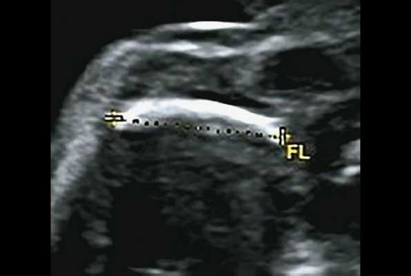 УЗИ плода - изогнутая и укороченная бедренная кость (беременность 24 нед)