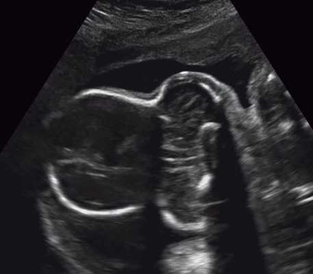 УЗИ плода - форма головы трилистник (беременность 26,5 нед)