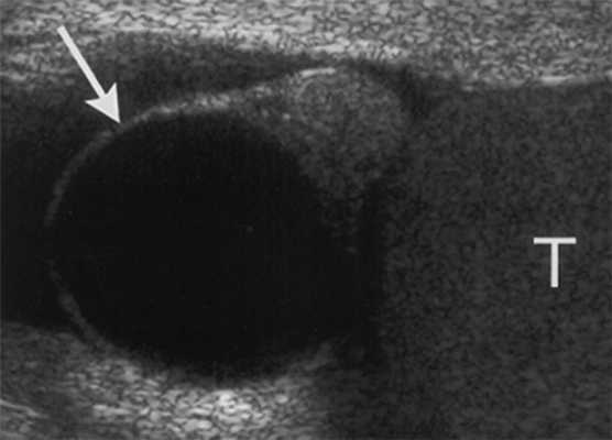 киста яичников на УЗИ