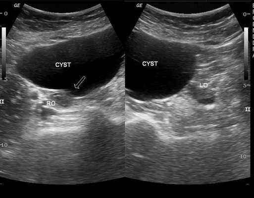 Параовариальная киста на УЗИ