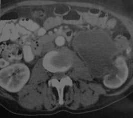 Снимки МРТ и КТ. Пионефроз
