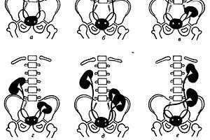 Виды дистопии почек
