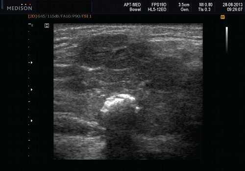 Эхограмма - камень в паренхиме поднижнечелюстной слюнной железы