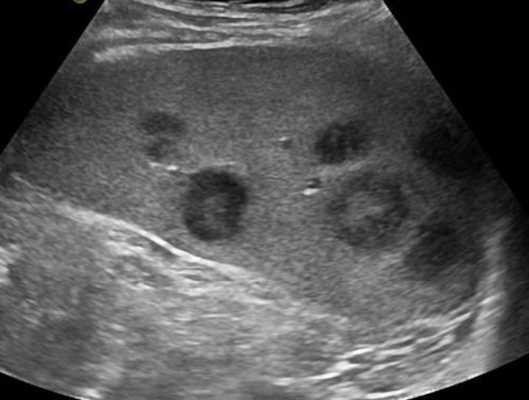 Увеличение лимфатических узлов при лимфогранулематозе