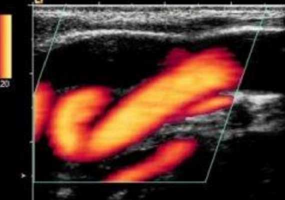 Что показывает УЗИ сосудов шеи и головы 