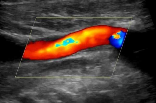 Изображение сонной артерии в режиме Допплера 