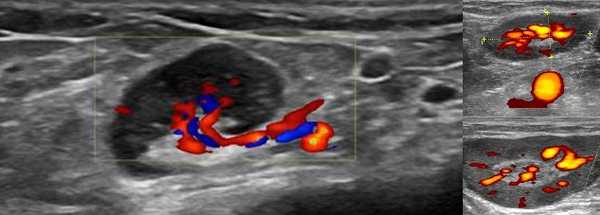  На сонограмме видно, что исследуемый лимфоузел увеличился. В режиме допплерографии визуализируется кровоток в зоне интереса