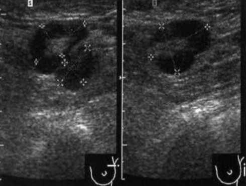  Метастазы рака молочной железы в поверхностных лимфоузлах