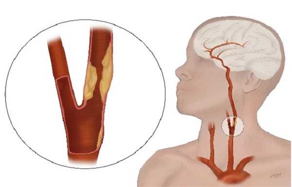 Атеросклеротическая бляшка в области бифуркации ОСА