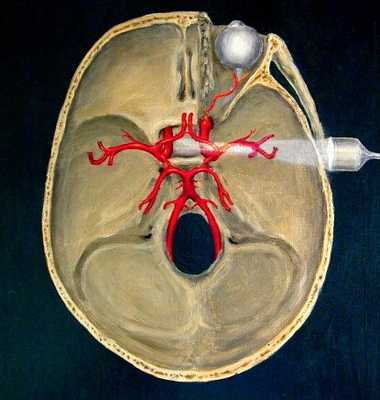 Транскраниальная допплерография