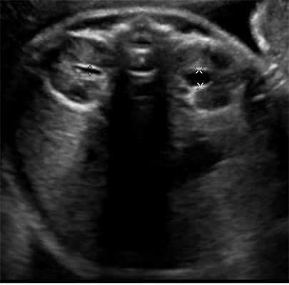 Гидронефроз у плода, новорожденных и детей