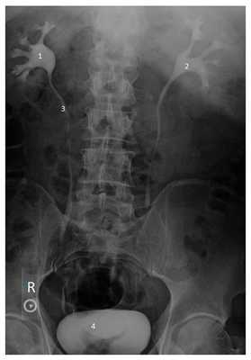 Степени гидронефроза