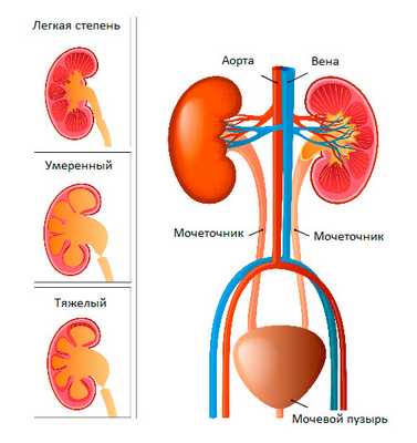 Гидронефроз у плода, новорожденных и детей