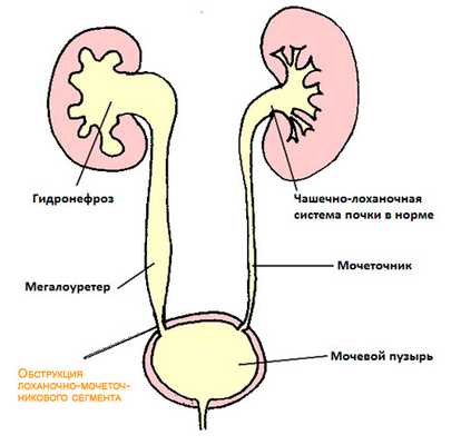 Гидронефроз у плода, новорожденных и детей