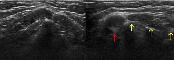  УЗИ аксиллярных лимфоузлов