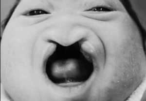 Анэнцефалия