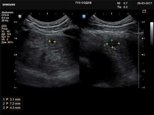 Тимус - киста, B-режим (эхограмма №736)
