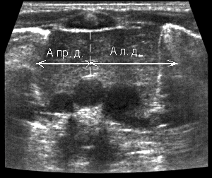 Тимус поперечный