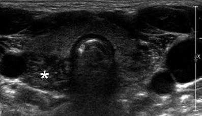 Тимус при плаче