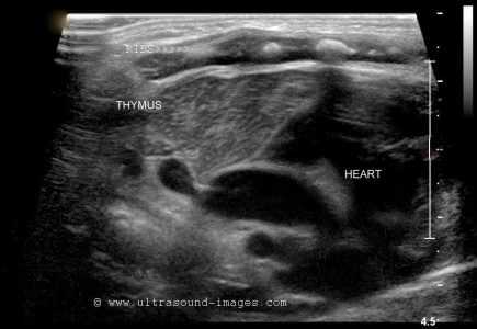 Тимус у новорожденного