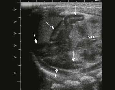 Тимус на шее поперечный срез
