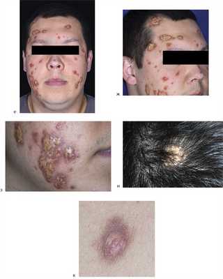 Гемофагоцитарный лимфогистиоцитоз