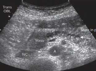 Поперечное сканирование в эпигастральной области