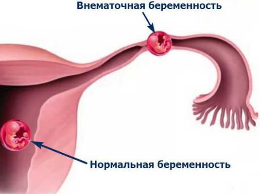 Внематочная беременность