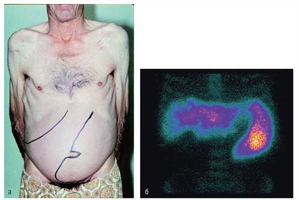 Спленомегалия