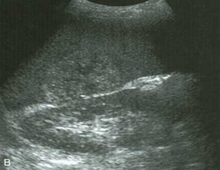 Добавочные доли селезенки