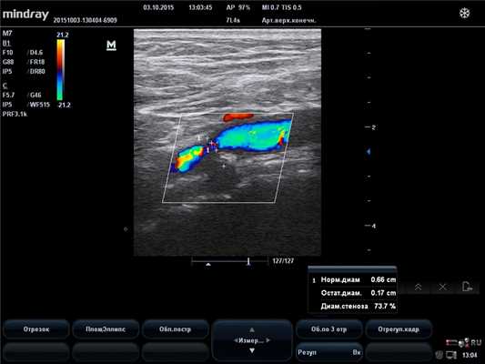 Стеноз сонной артерии на УЗИ