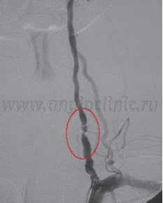 Сужение позвоночной артерии