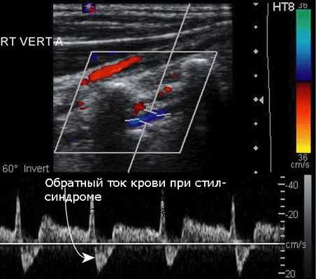 УЗИ позвоночной артерии 