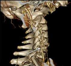 Компьютерная томография при патологии позвоночной артерии