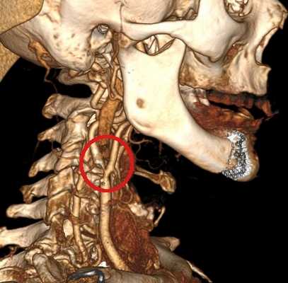 Атеросклероз, критический стеноз внутренней сонной артерии