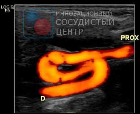 УЗИ сонных артерий при извитости